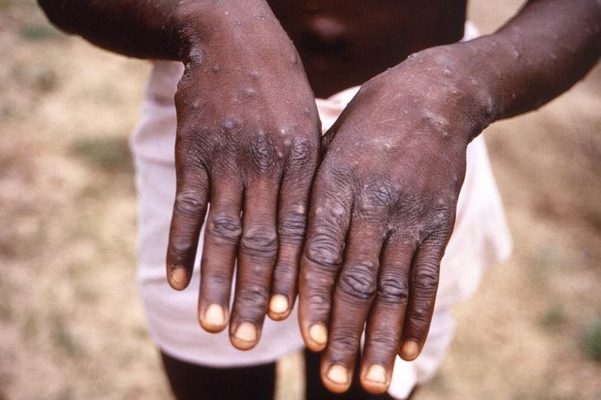 Featured Post Image - Monkeypox: Dari awal di Afrika hingga menjadi darurat kesehatan global